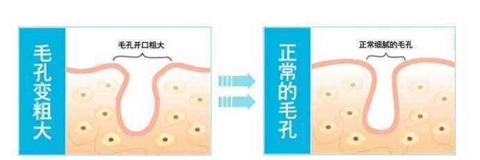 毛孔粗大的原因及解决方法（深入探讨造成毛孔粗大的因素及有效解决之道）